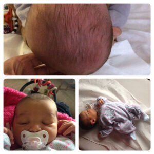 syndrome postural asymétrique